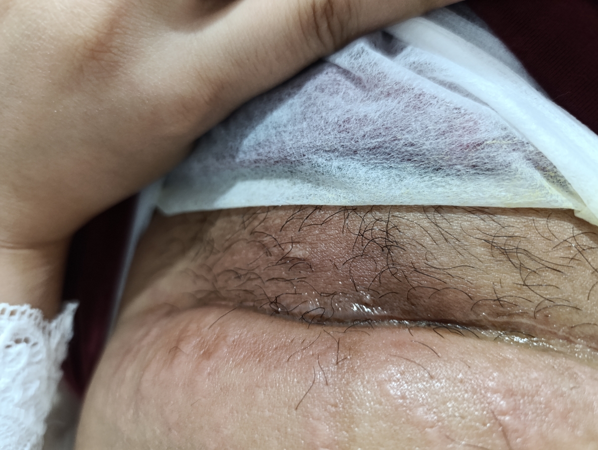 درد محل زخم سزارین درد محل زخم سزارین