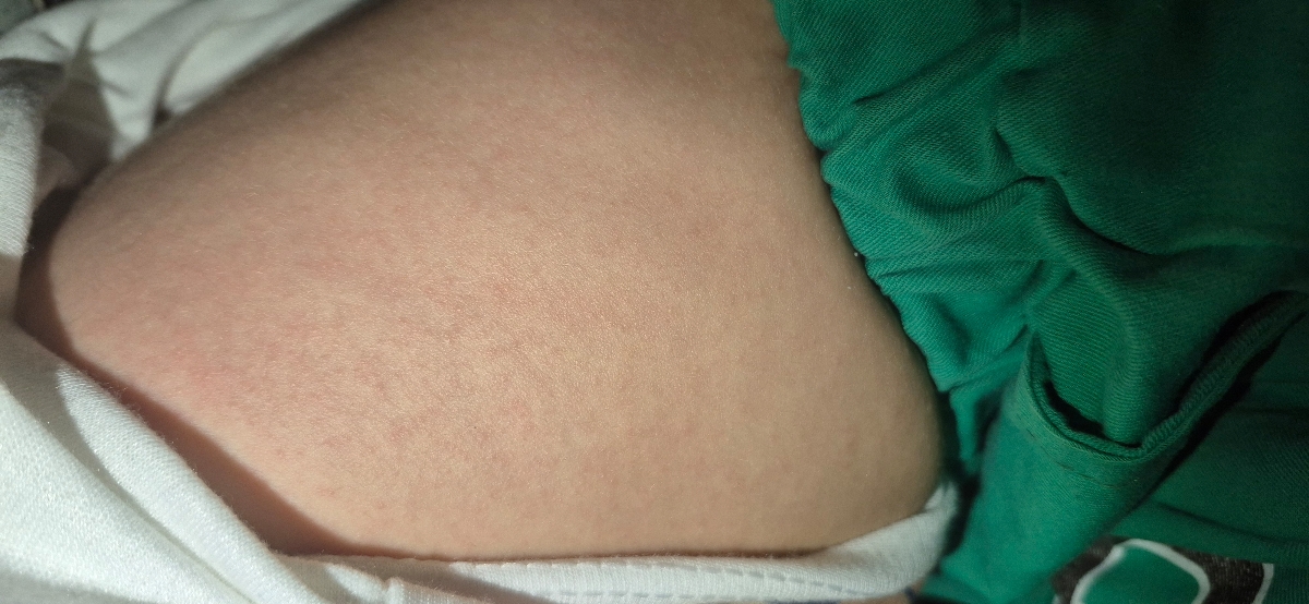 دکتر جان این سرخکه یا آلرژی؟