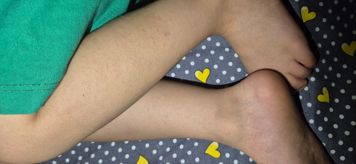 دکتر جان این سرخکه یا آلرژی؟