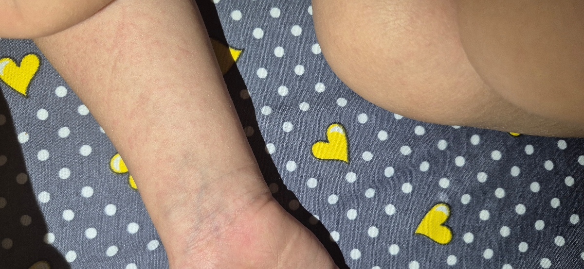 دکتر جان این سرخکه یا آلرژی؟