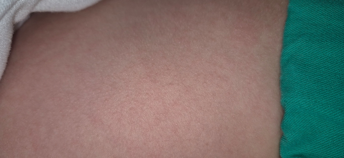 دکتر جان این سرخکه یا آلرژی؟