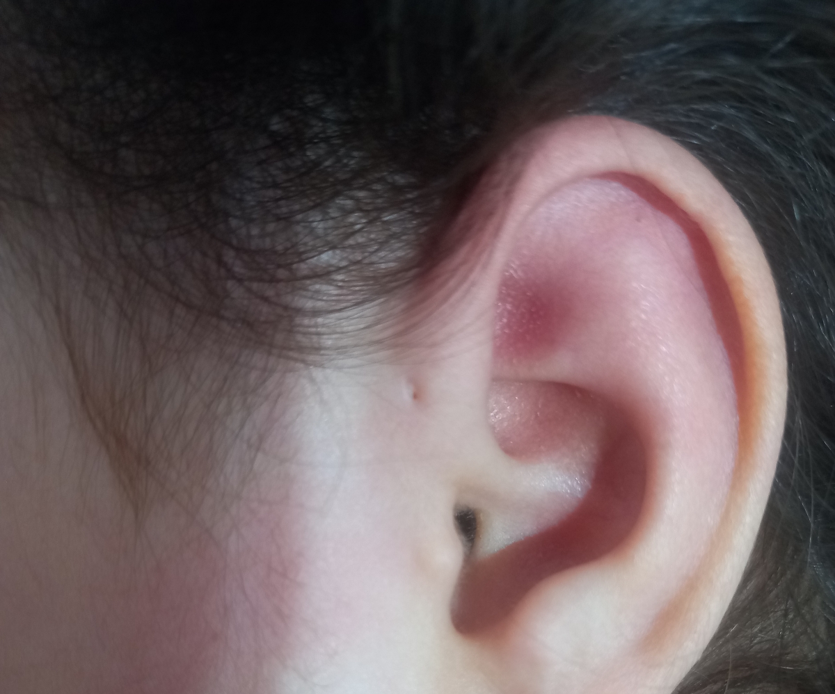 سوراخ روی گوش کودک ۳ساله
