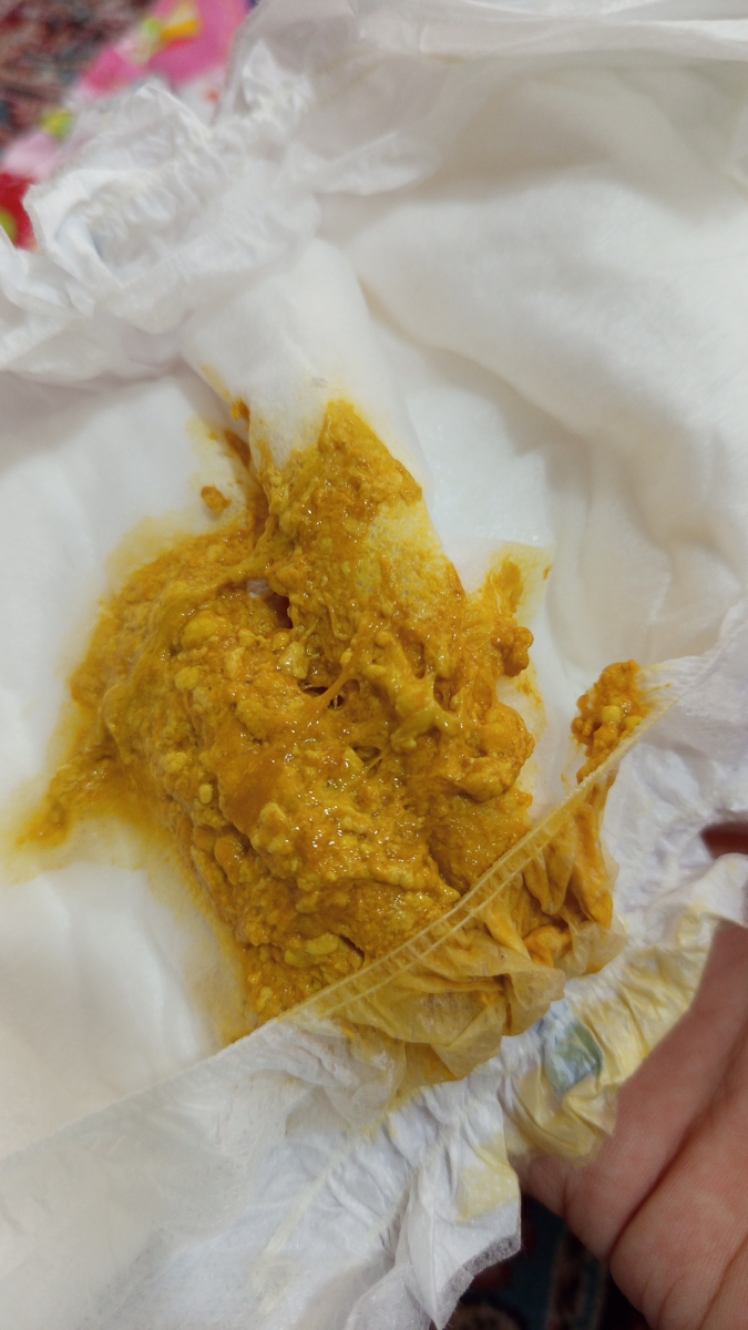 خون در مدفوع نوزاد چند قطره خون در مدفوع نوزاد چند قطره