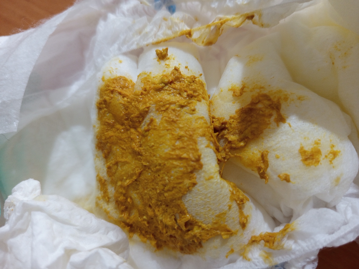 خون در مدفوع نوزاد چند قطره خون در مدفوع نوزاد چند قطره