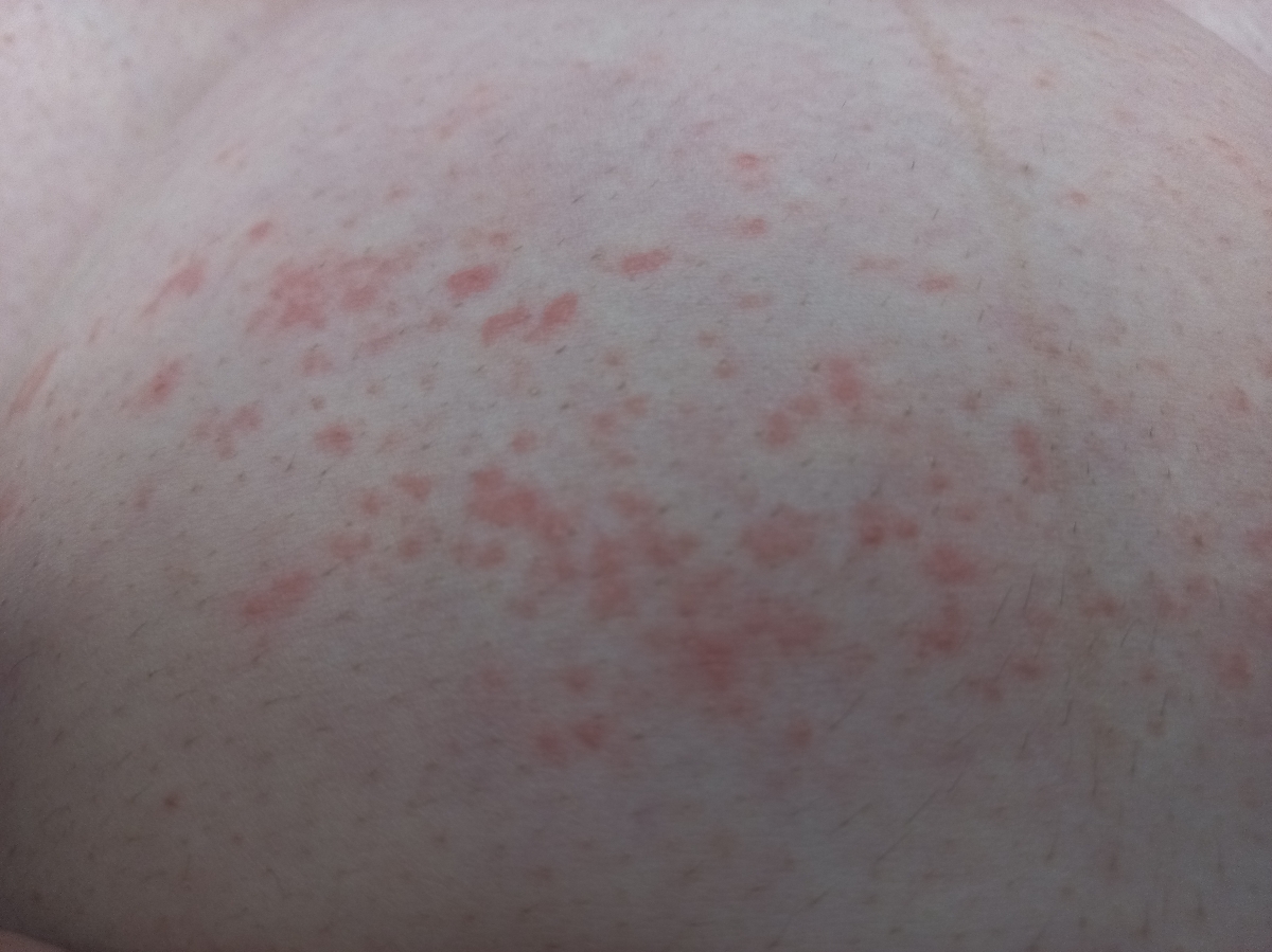به وجود آمدن دونه های ریز قرمز روی پوست به وجود آمدن دونه های ریز قرمز روی پوست