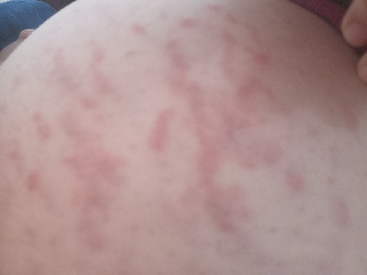 به وجود آمدن دونه های ریز قرمز روی پوست به وجود آمدن دونه های ریز قرمز روی پوست