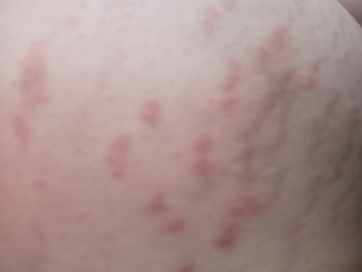 به وجود آمدن دونه های ریز قرمز روی پوست به وجود آمدن دونه های ریز قرمز روی پوست