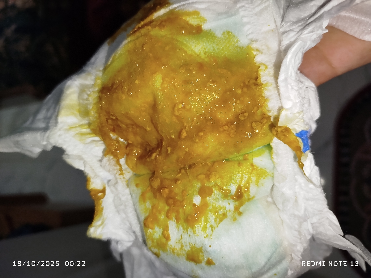 خلطی بودن مدفوع نوزاد دو ماهه خلطی بودن مدفوع نوزاد دو ماهه