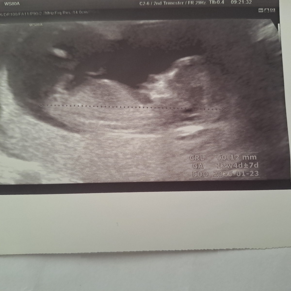 جواب آزمایش؟؟؟؟ احتمال دوقلویی جواب آزمایش؟؟؟؟ احتمال دوقلویی