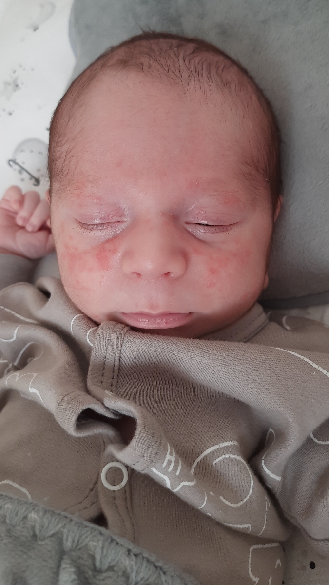 التهاب و قرمزی صورت نوزاد ۲۰ روزه التهاب و قرمزی صورت نوزاد ۲۰ روزه