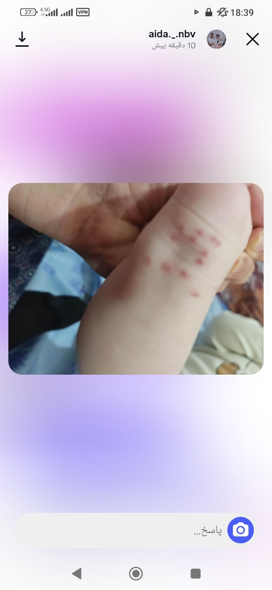 نیش حشره یا حساسیت به جوراب