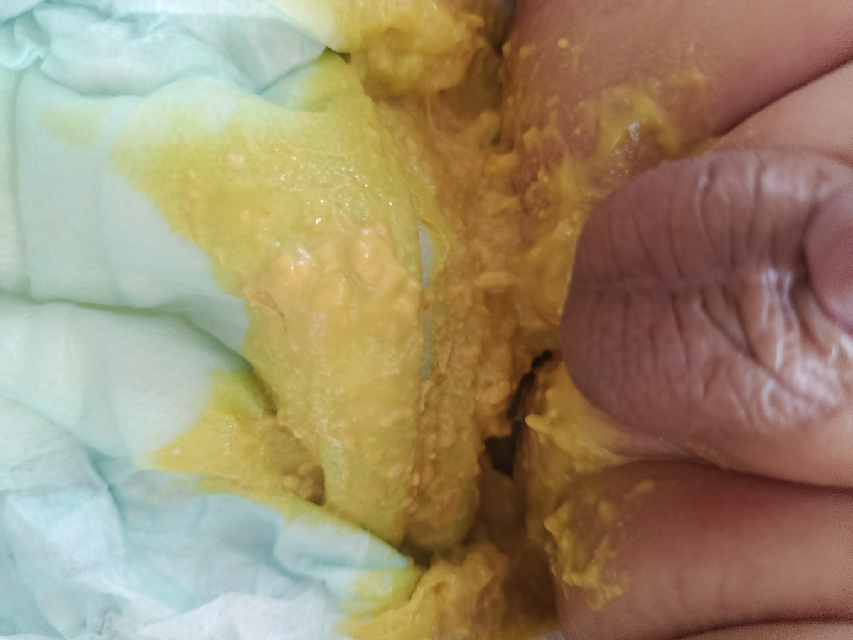 مدفوع نوزاد چهارماهه ب رنگ زرد(+عکس) مدفوع نوزاد چهارماهه ب رنگ زرد(+عکس)