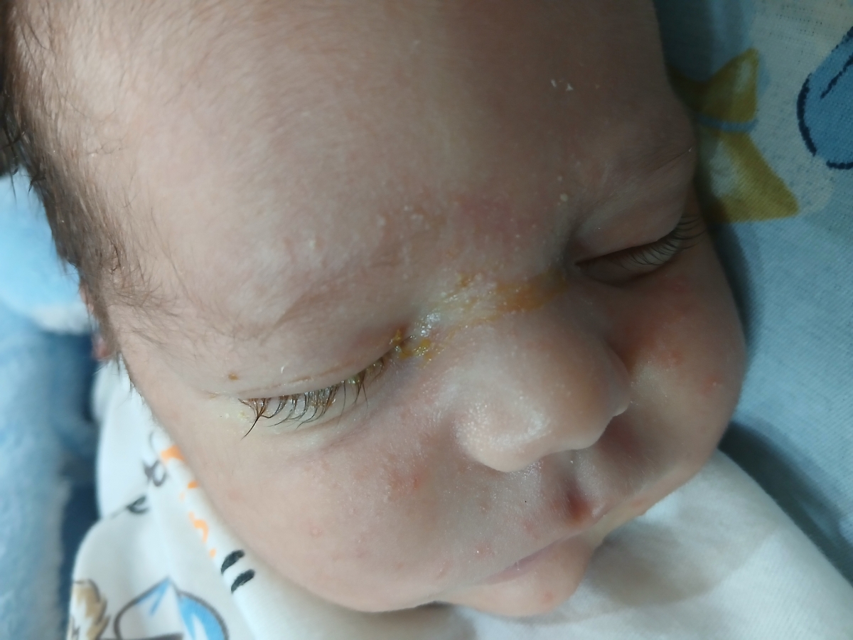 ترشح چشم نوزاد لطفا کمک کنید