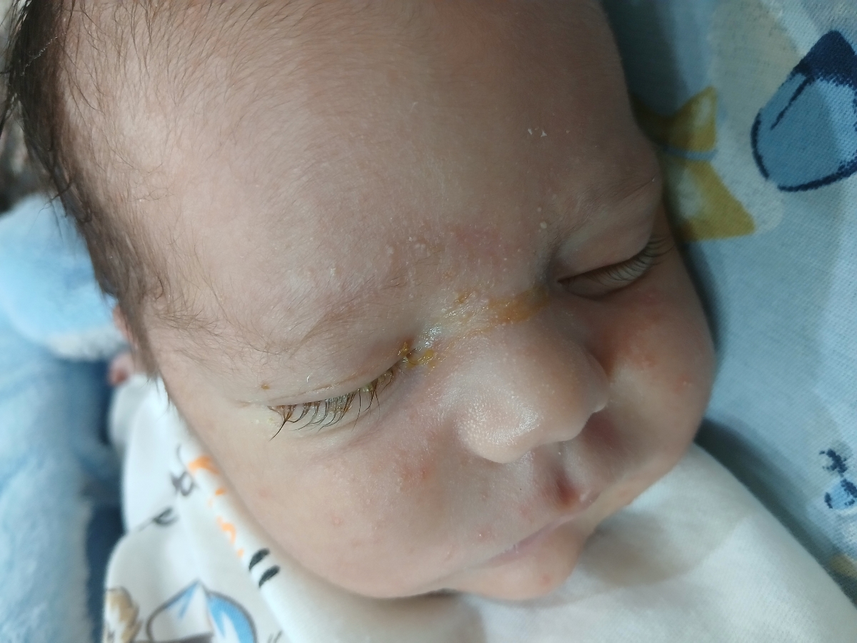 ترشح چشم نوزاد لطفا کمک کنید