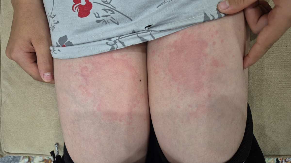 سلام آیا کهیر شدید ویروس میشه؟؟