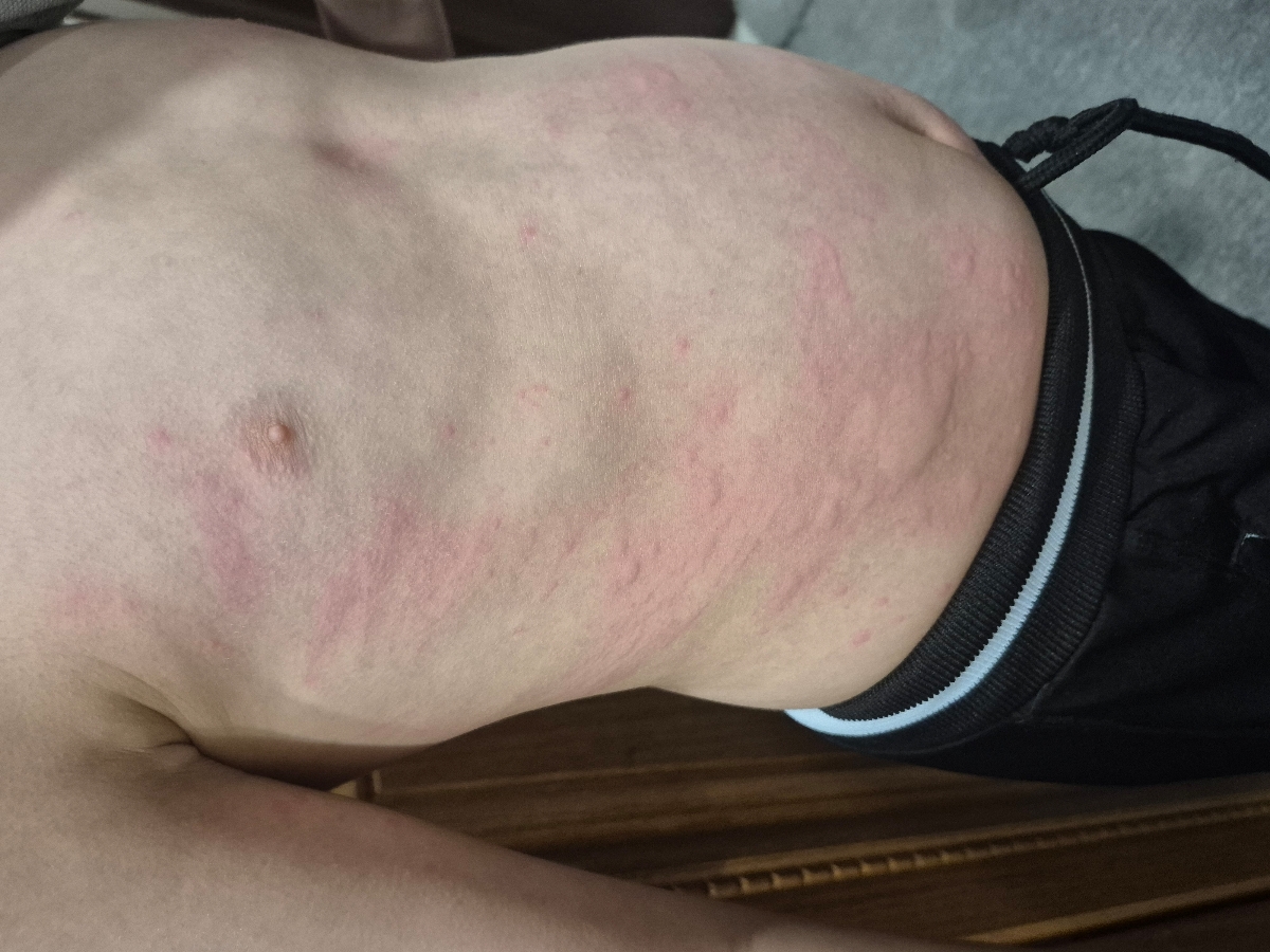 سلام آیا کهیر شدید ویروس میشه؟؟