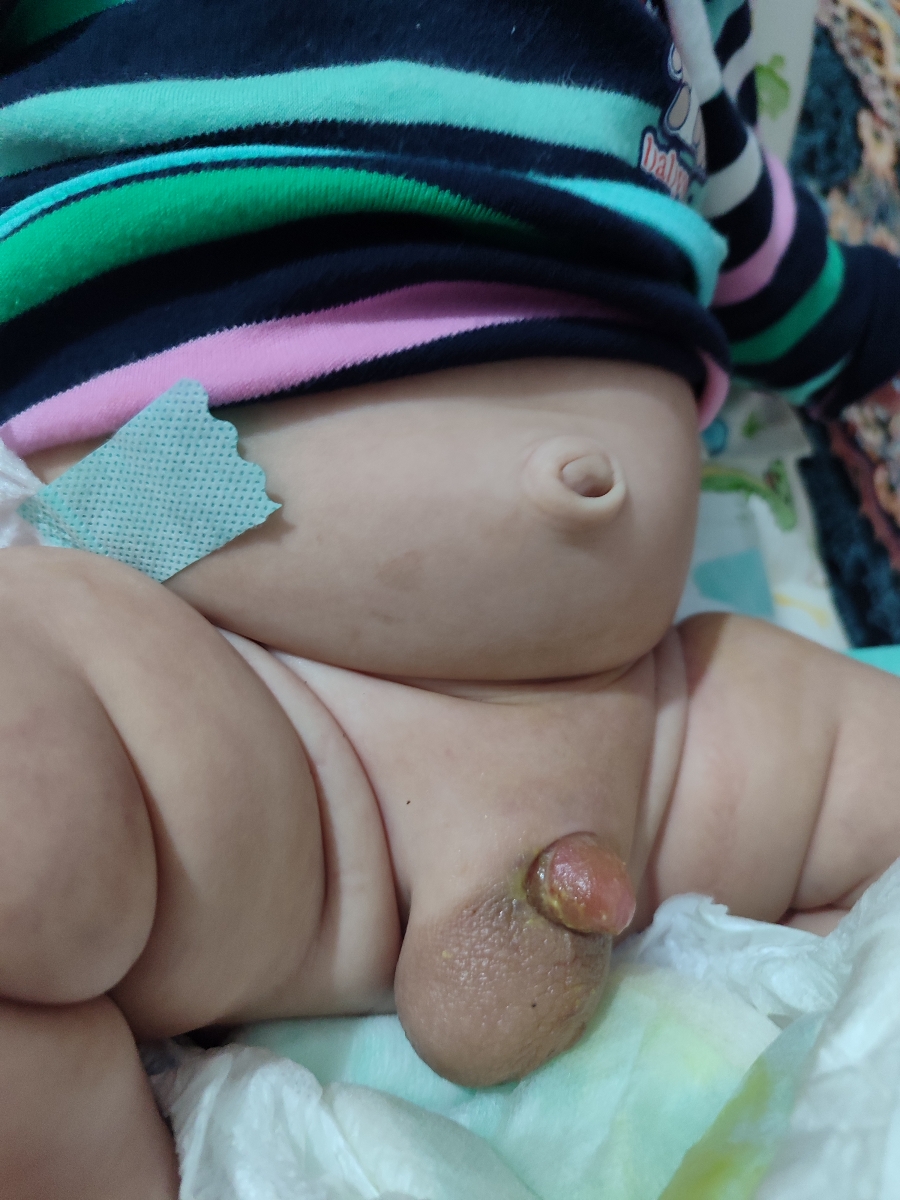 کوچک بودن آلت و ختنه کردن کوچک بودن آلت و ختنه کردن