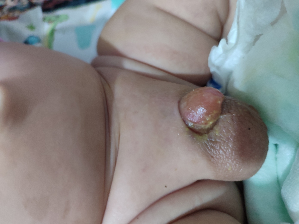 کوچک بودن آلت و ختنه کردن کوچک بودن آلت و ختنه کردن