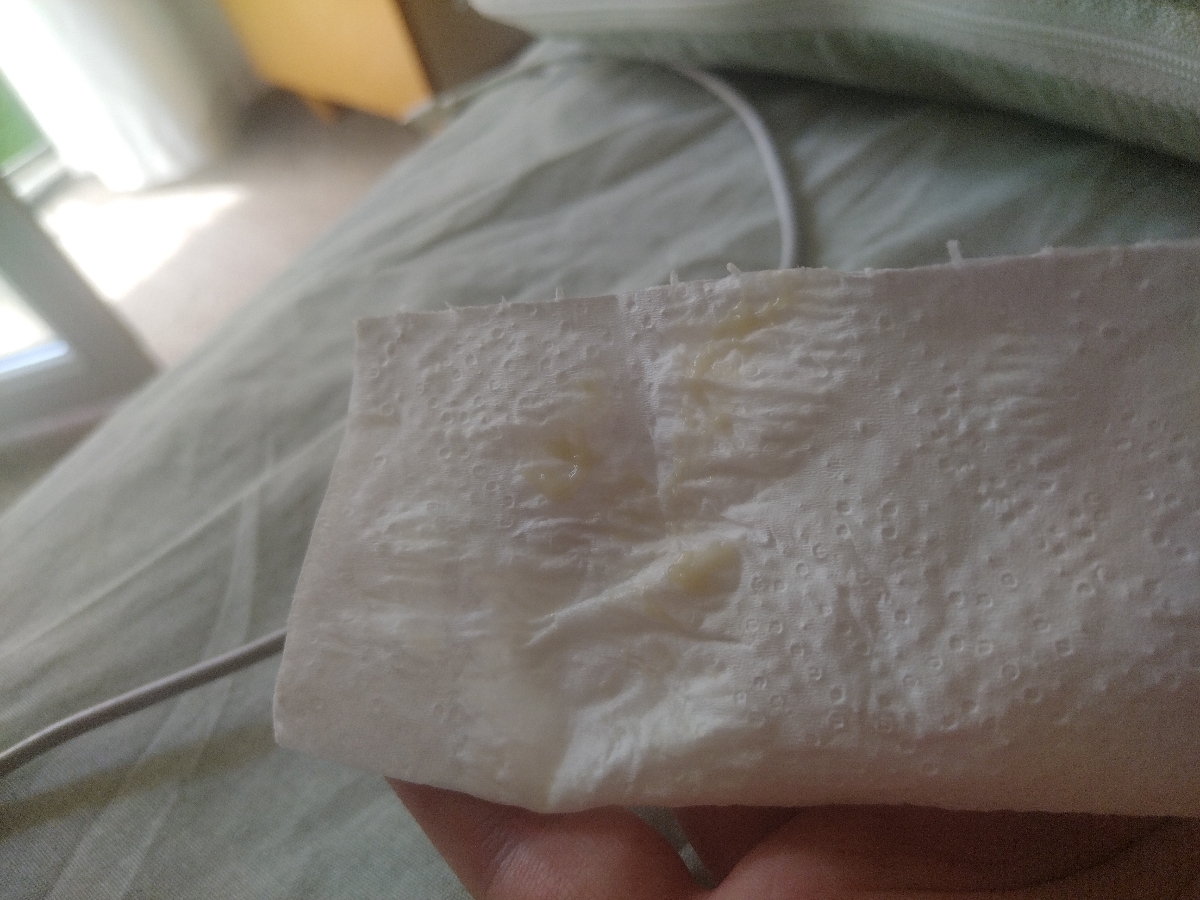 خانم دکتر خیلی عذر میخوام بابت ارسال عکس
خیلی کم خارش دارم. تازه اینجور شدم. 