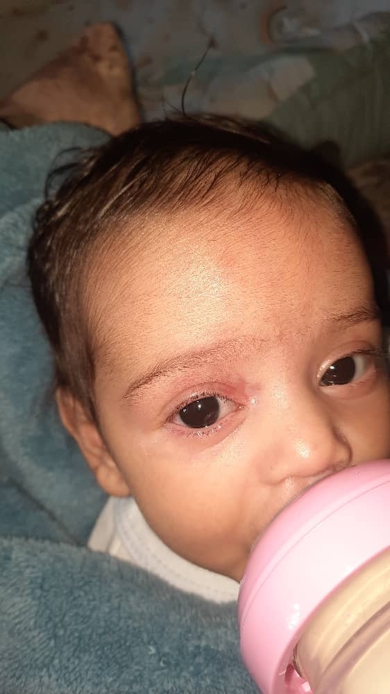 عفونت چشم نوزاد سه ماهه عفونت چشم نوزاد سه ماهه