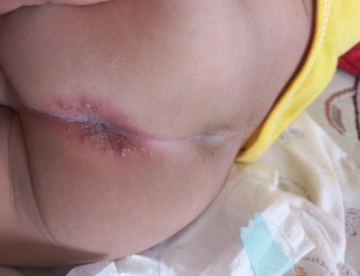 جوش سرسفید دور مقعد نوزاد