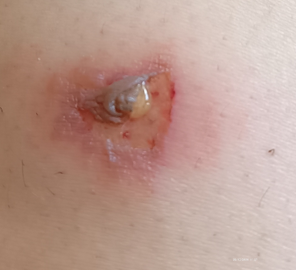 عفونت زخم سوختگی براثر بخاراتو