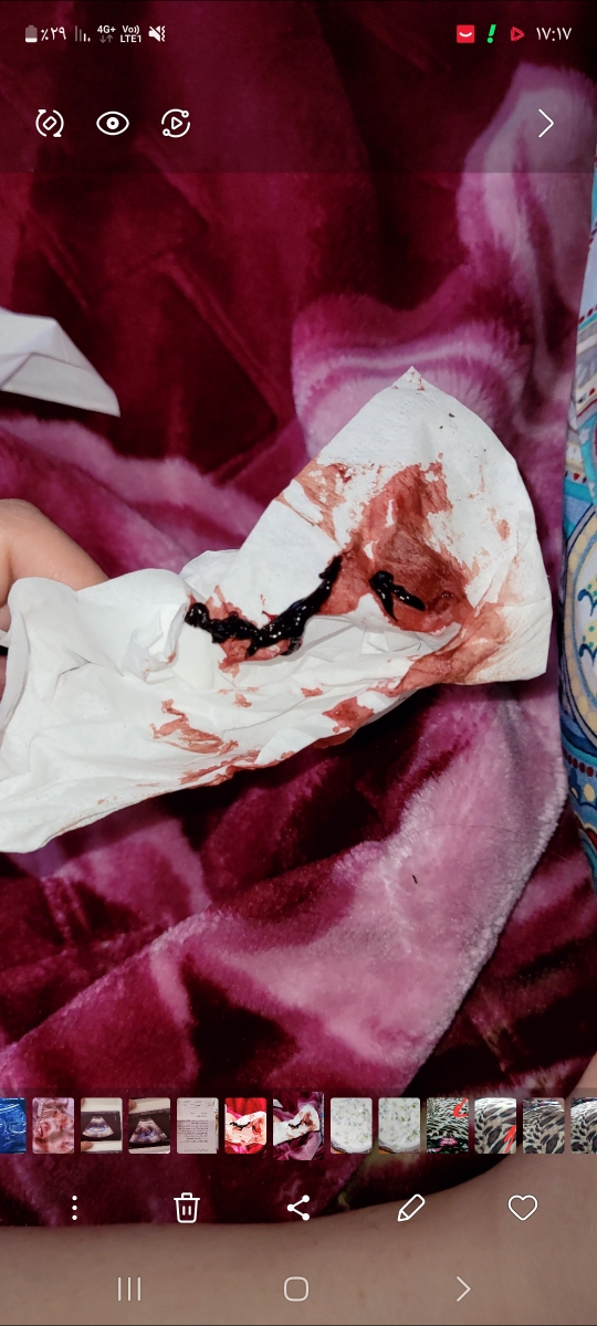 برا منم ۶ ماهگی پسرم این بود هماتوم بود برا منم ۶ ماهگی پسرم این بود هماتوم بود