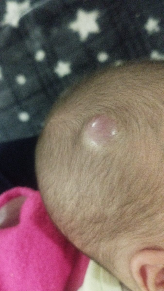 خانم دکتر وخانمایی عزیز سوالم درباره همانژیومه لطفا بیاید!!!