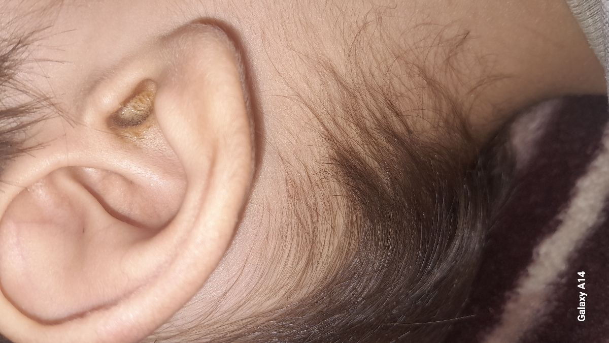 پسر۲سالو۶ماهم ترشح گوش طبیعیه