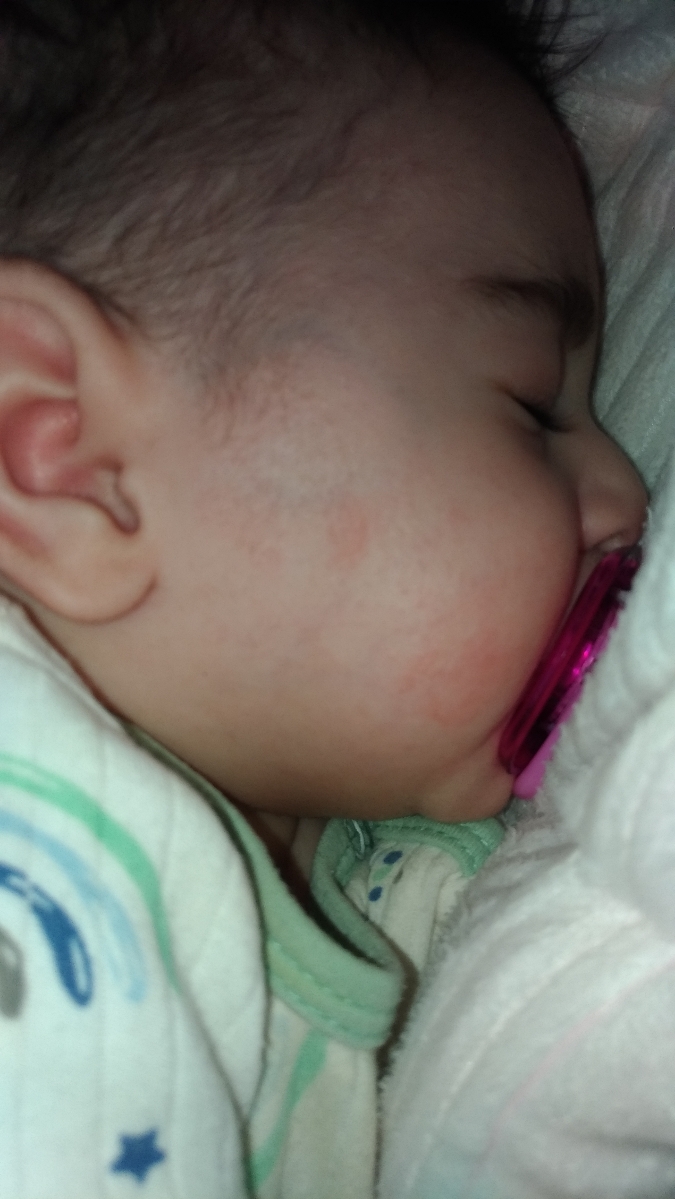 برفک دهان نوزاد و قرمزی ناحیه تناسلی