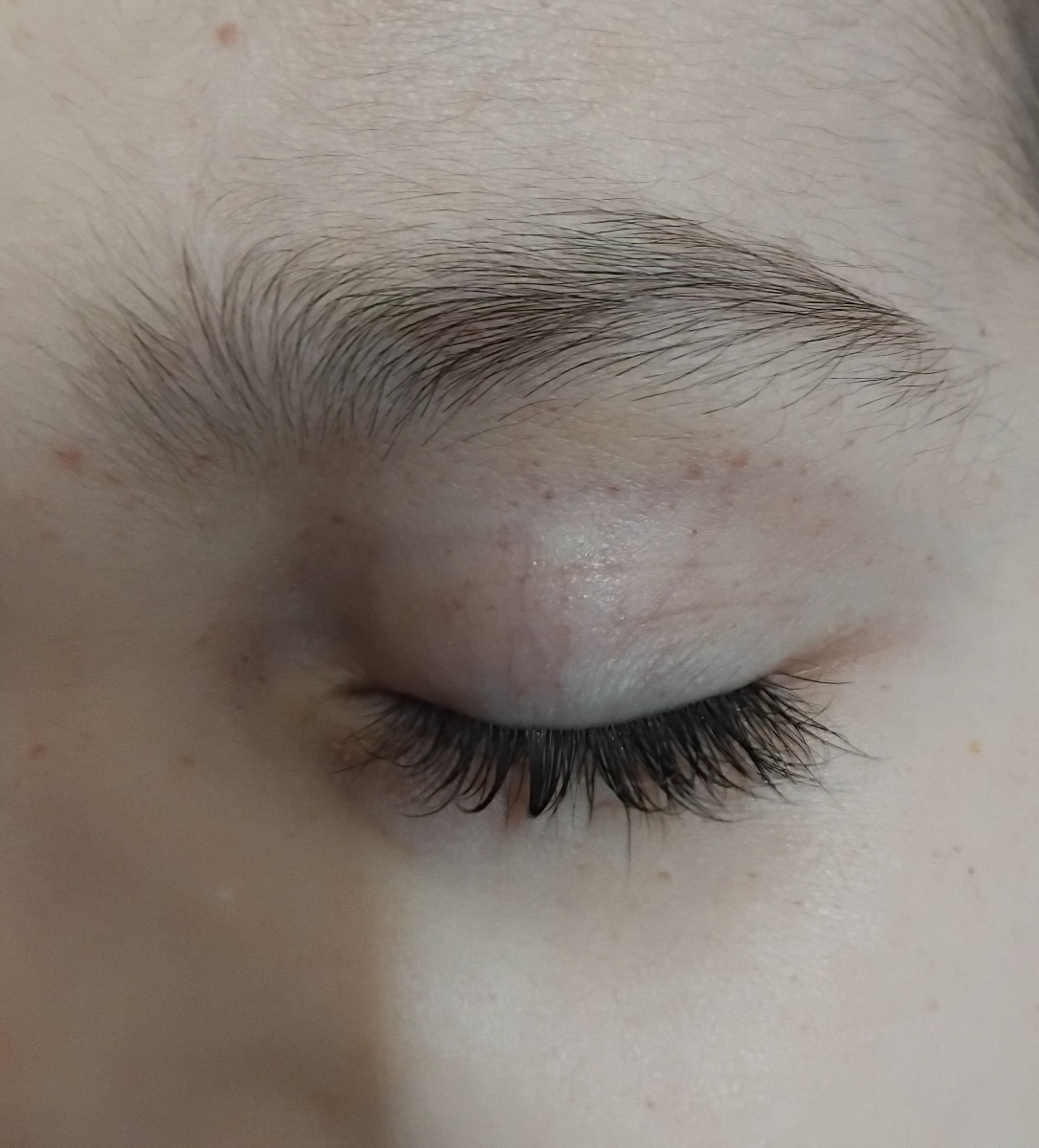 کک و مک و جوش و لک سفید رو صورت پسرمممم کک و مک و جوش و لک سفید رو صورت پسرمممم