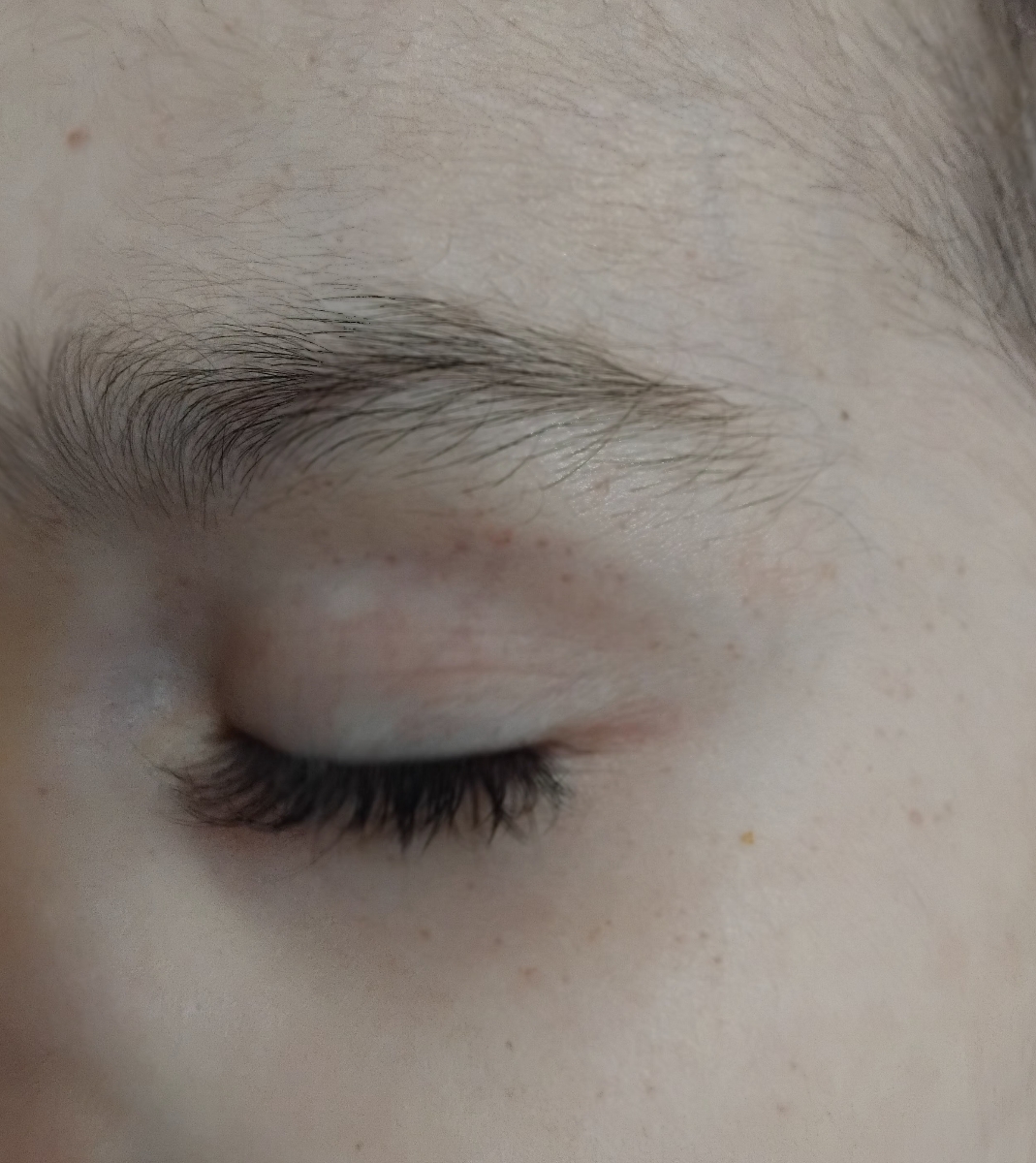 کک و مک و جوش و لک سفید رو صورت پسرمممم کک و مک و جوش و لک سفید رو صورت پسرمممم