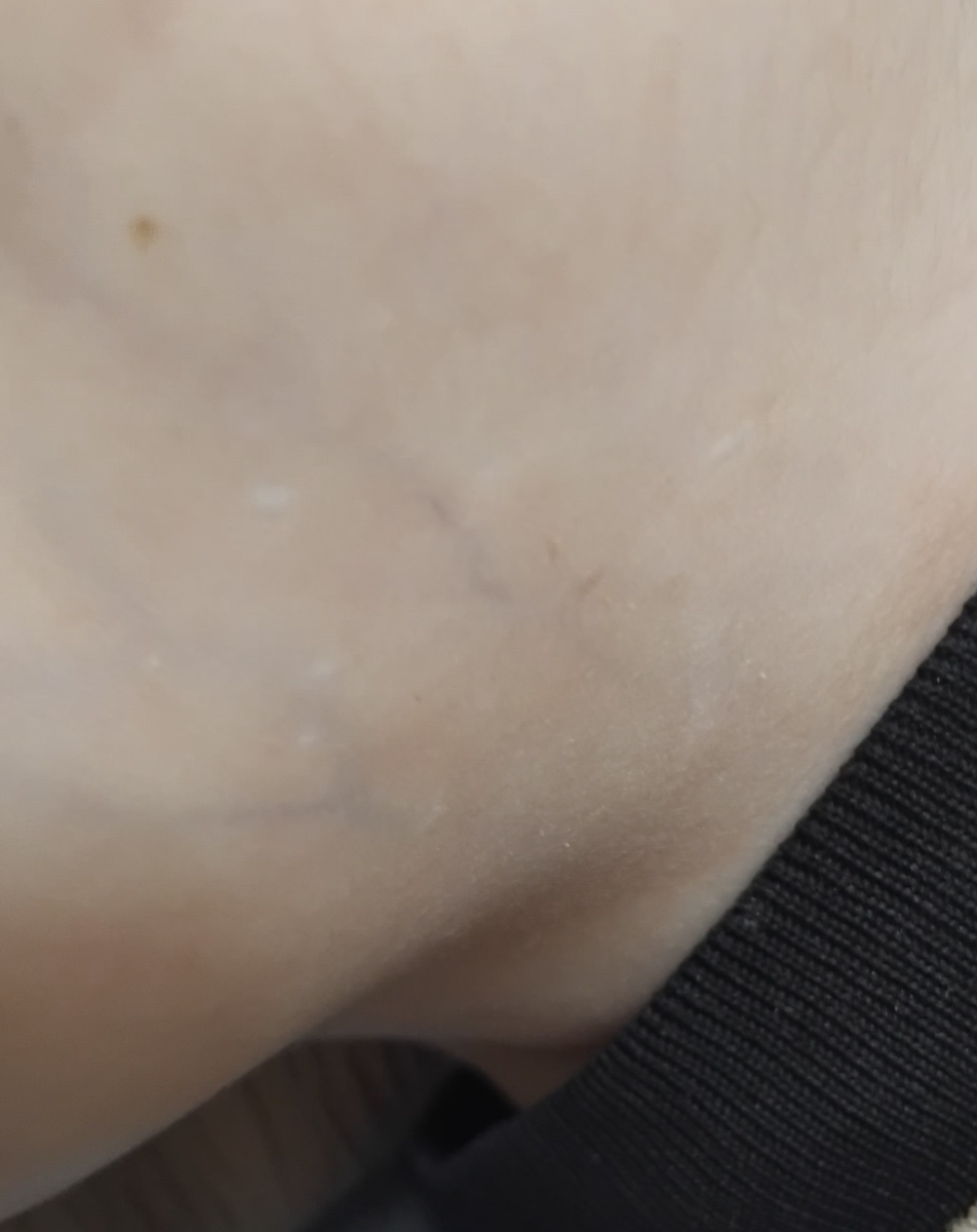 کک و مک و جوش و لک سفید رو صورت پسرمممم کک و مک و جوش و لک سفید رو صورت پسرمممم