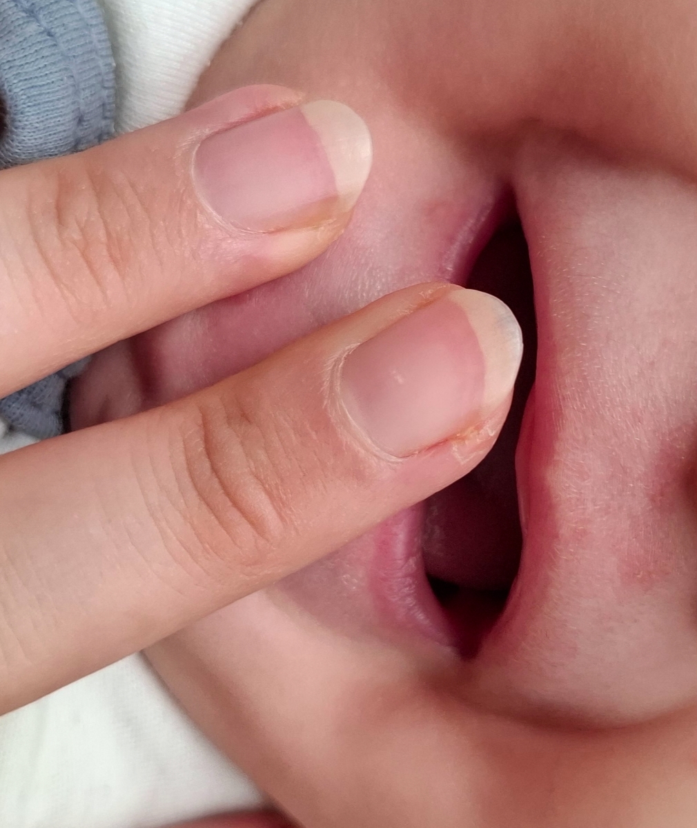 آیا اینا تبخاله؟همراه عکس آیا اینا تبخاله؟همراه عکس