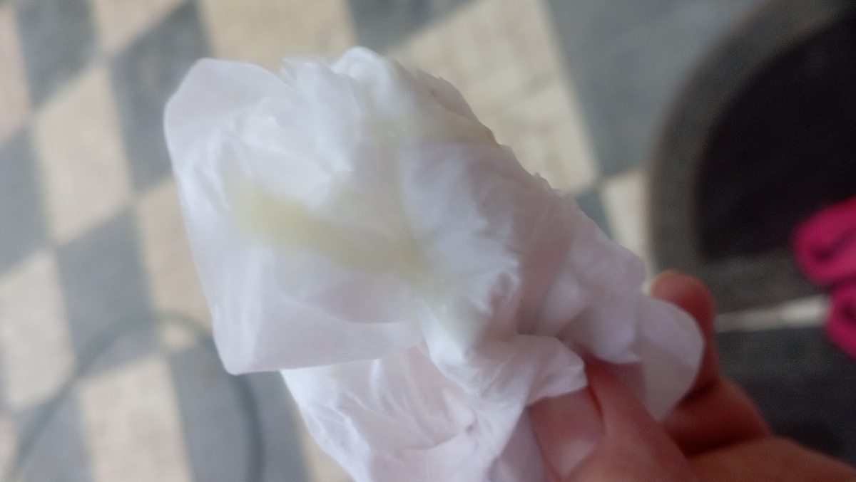 عفونت بارداری ترشحات سبز عفونت بارداری ترشحات سبز