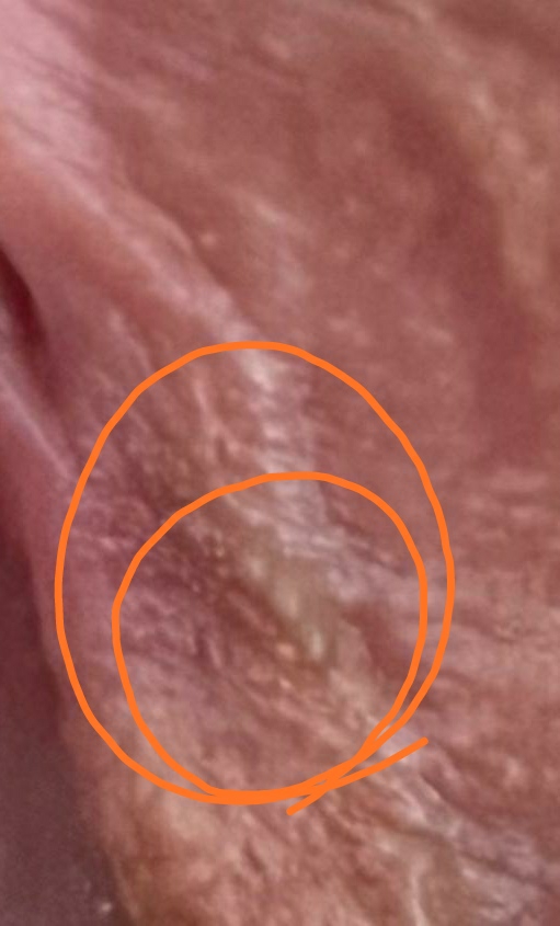 گوشت اضافه زگیل تناسلی همراه با عکس