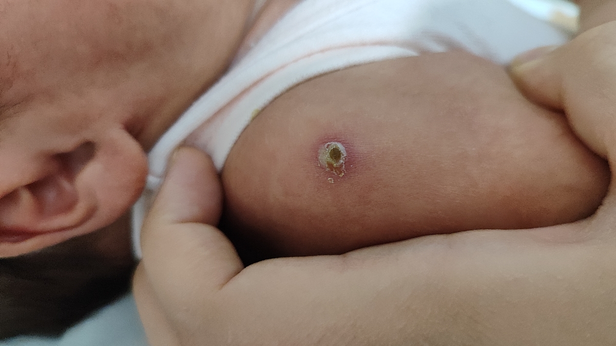 این جای واکسنشه که الان اینطوری شده چکار باید بکنم ؟؟