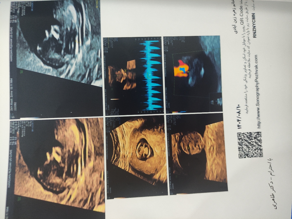 تفسیر سونوی ان تی