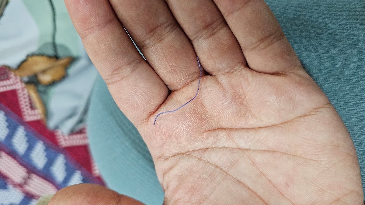 بخیه ی زایمان