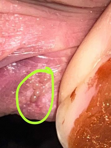 گوشت اضافه زگیل تناسلی همراه با عکس