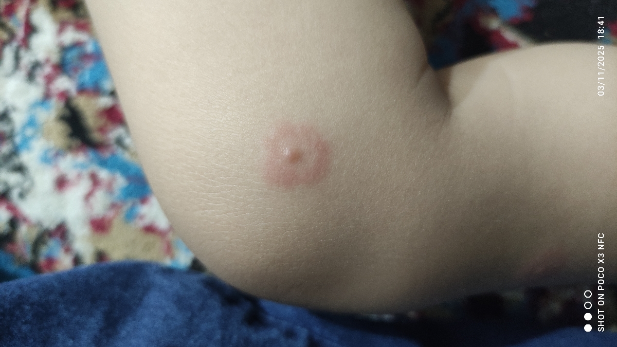 دونه قرمز روی صورت و پا و دست