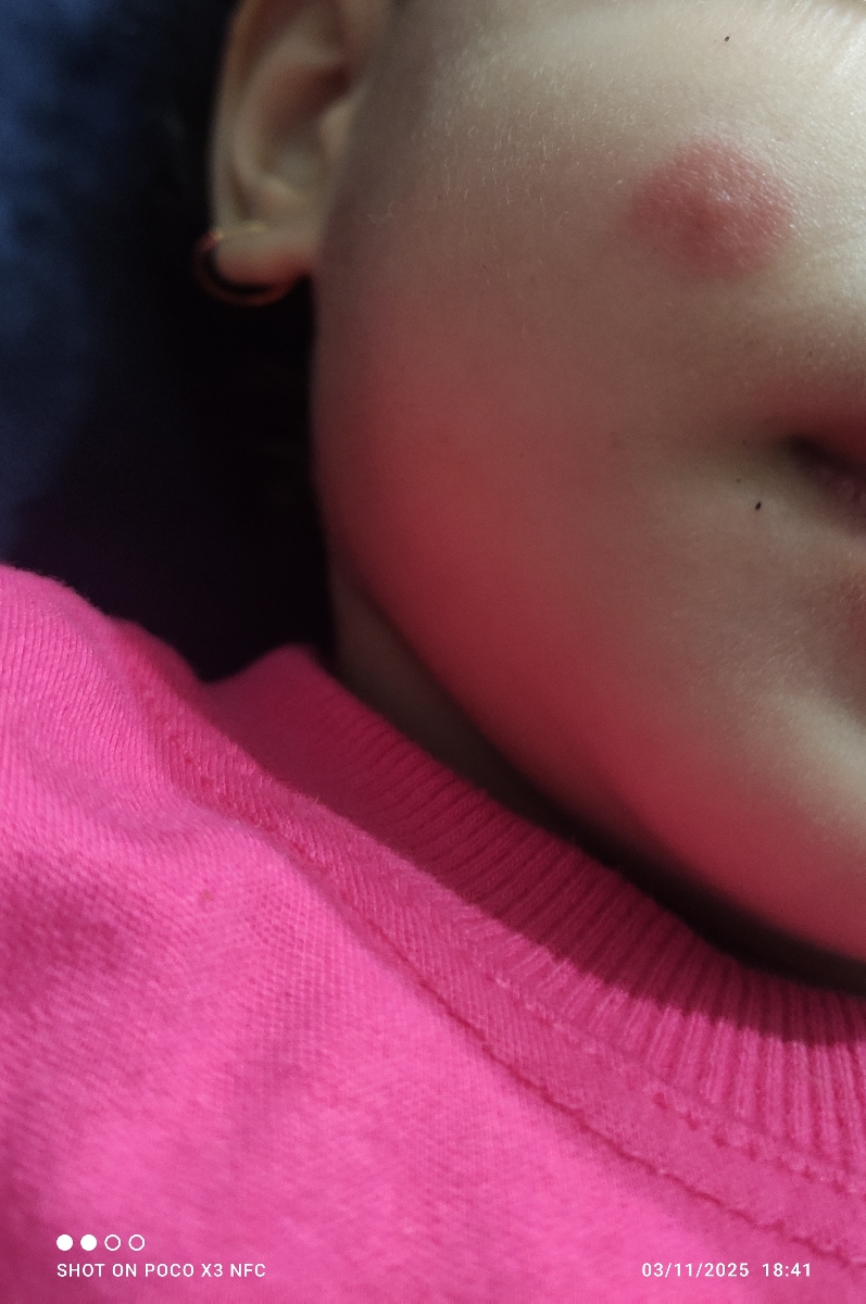 دونه قرمز روی صورت و پا و دست