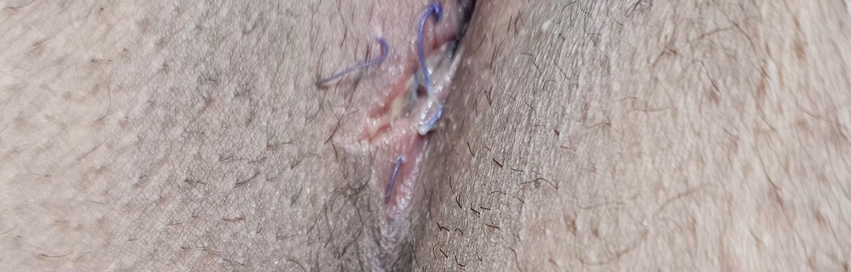 زایمان طبیعی و بخیه و عفونت