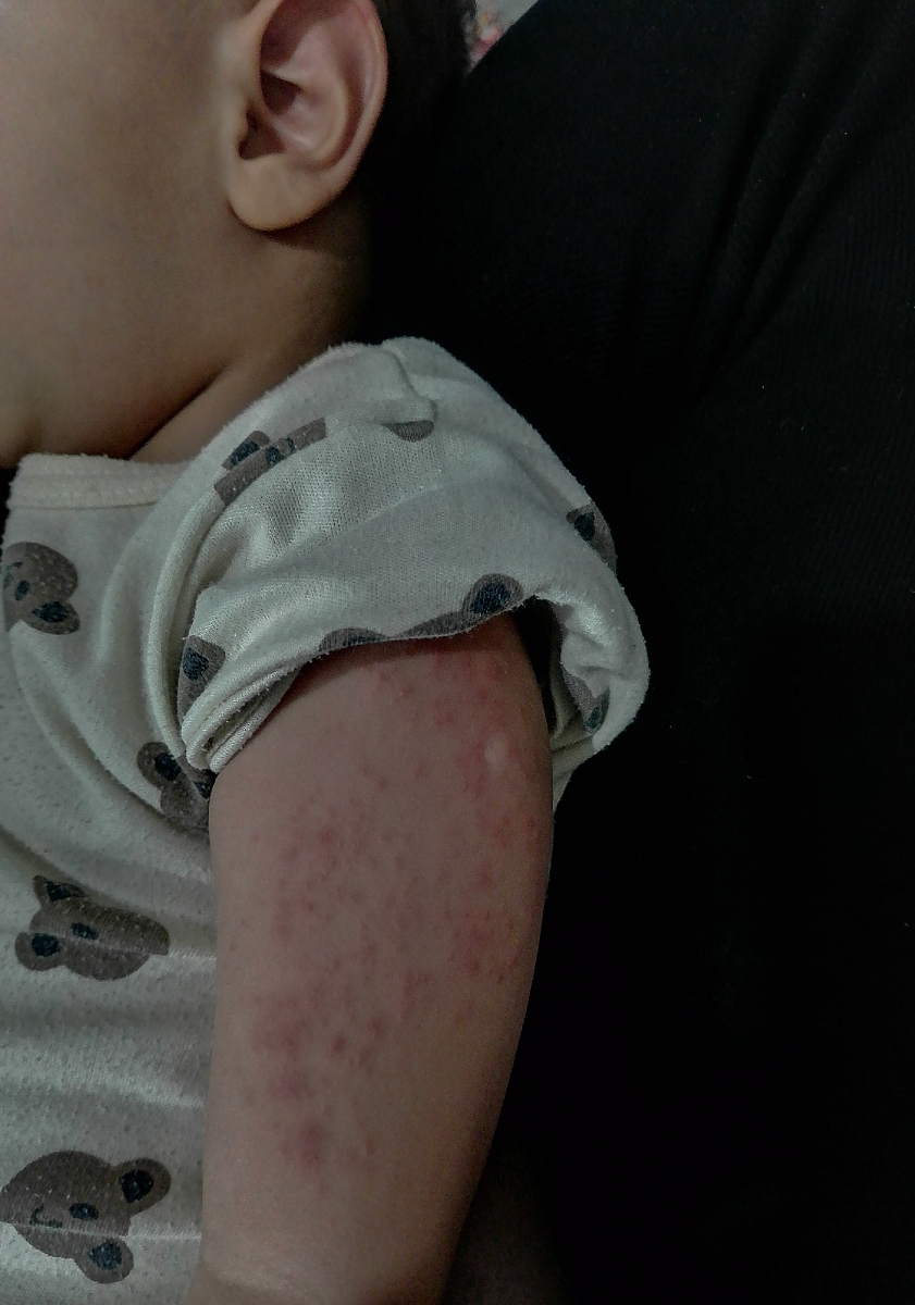 دونه ریختن بیرون شدید دونه ریختن بیرون شدید