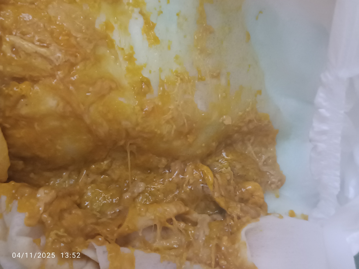 رفلاکس شدید نوزاد رفلاکس شدید نوزاد