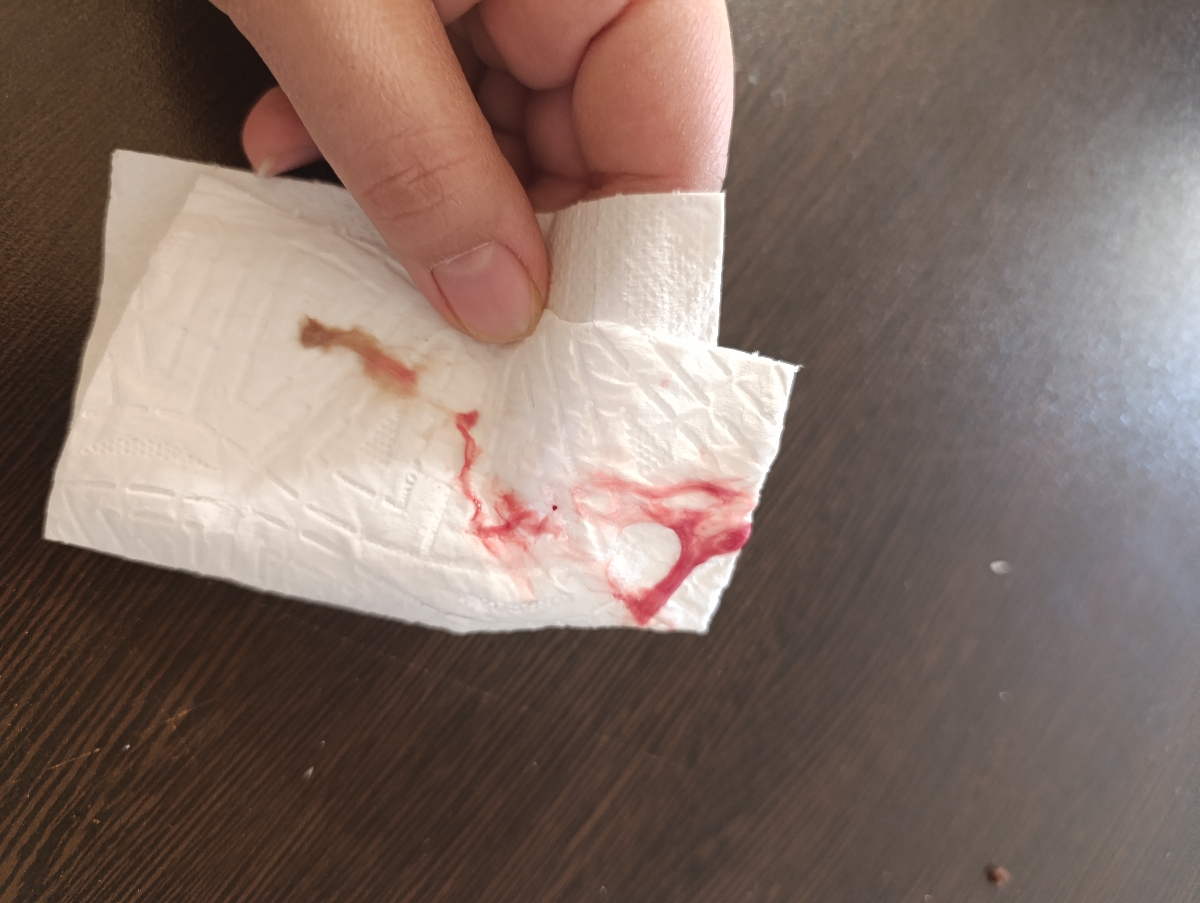 خونریزی بعد زایمان +عکس خونریزی بعد زایمان +عکس