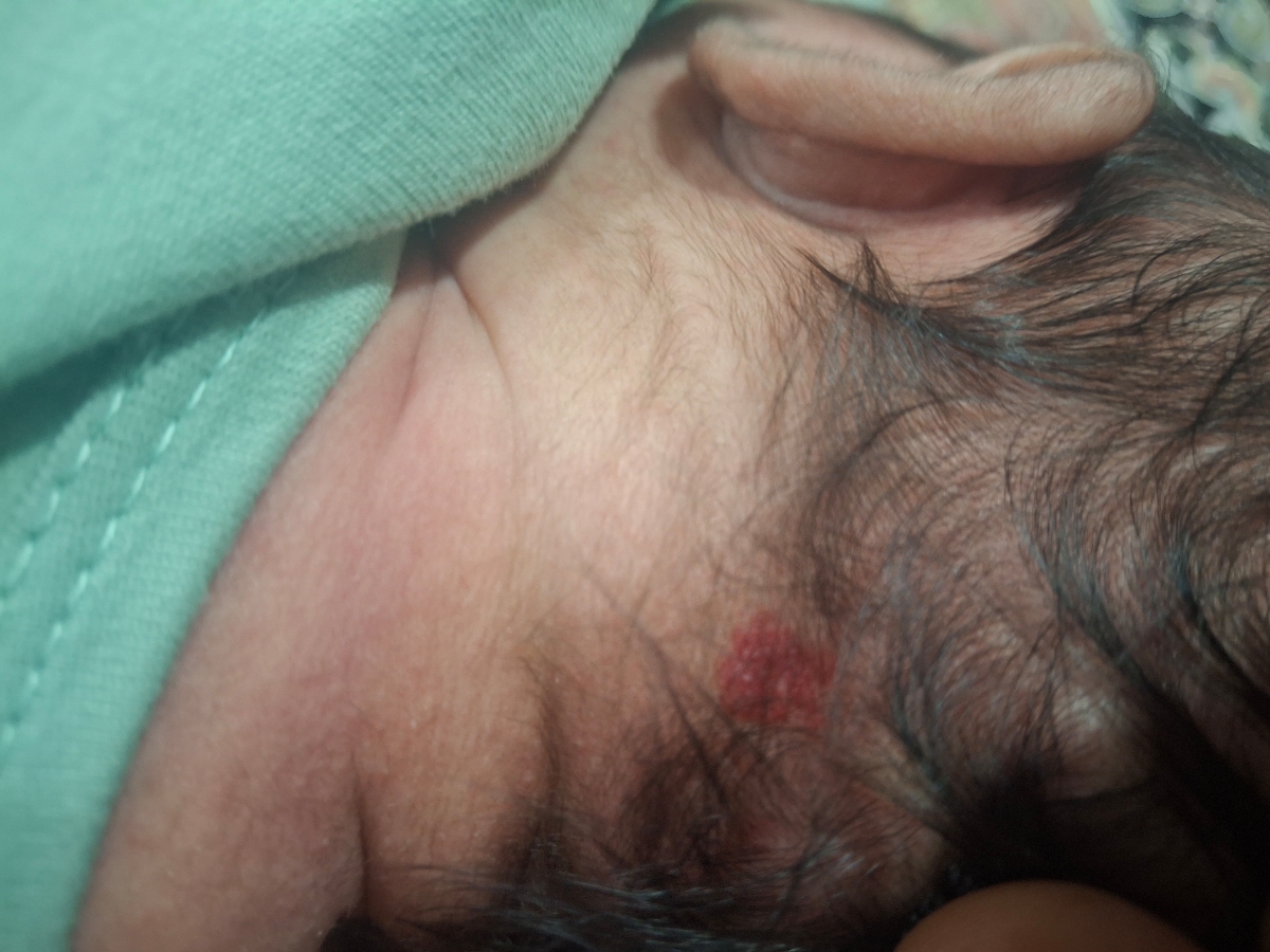 قرمزی پشت گردن نوزاد