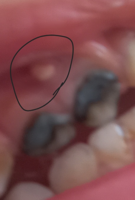 ابریزش شدید از دهان کودک