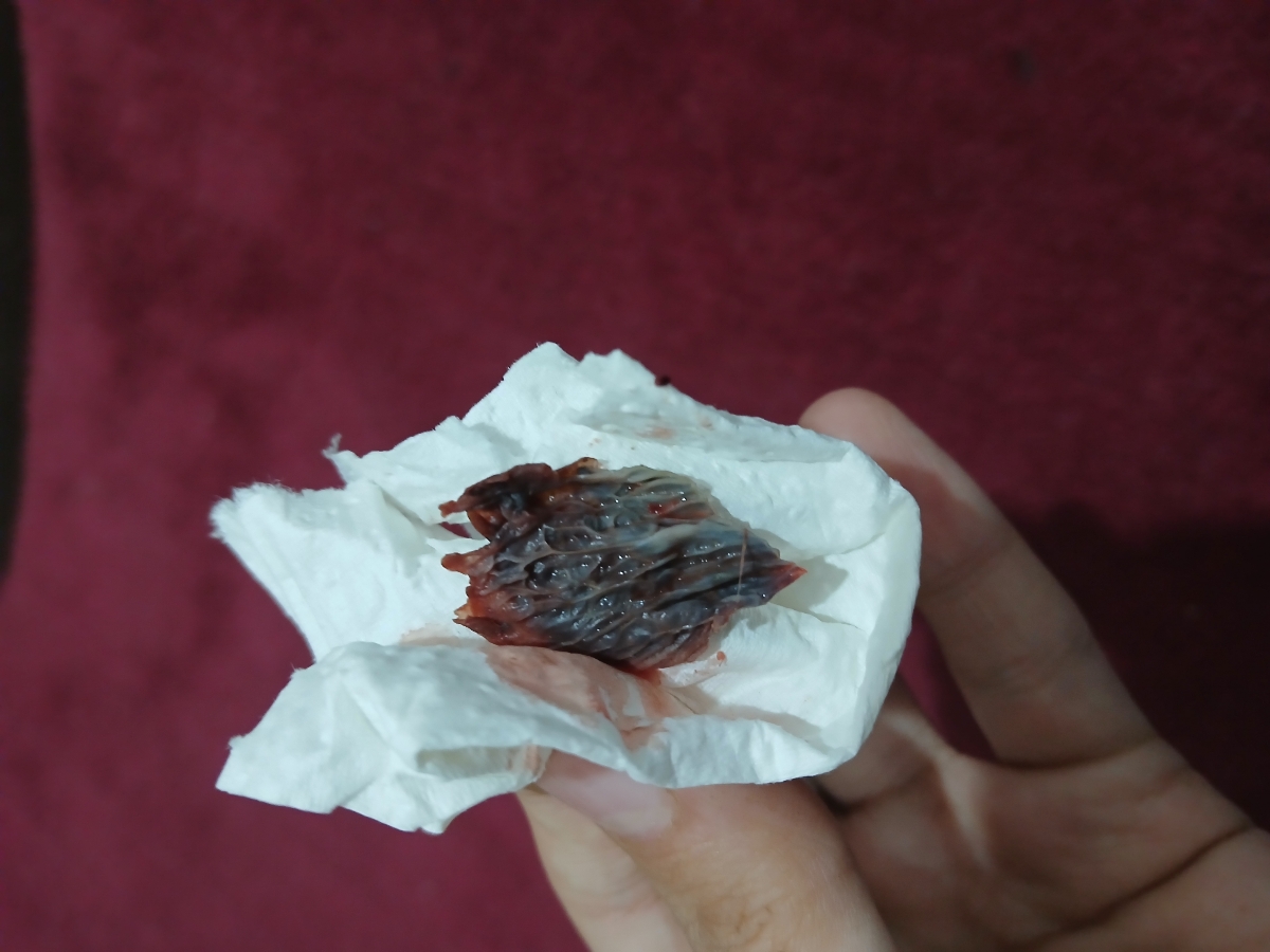 سقط لخته پریودی خون لخته