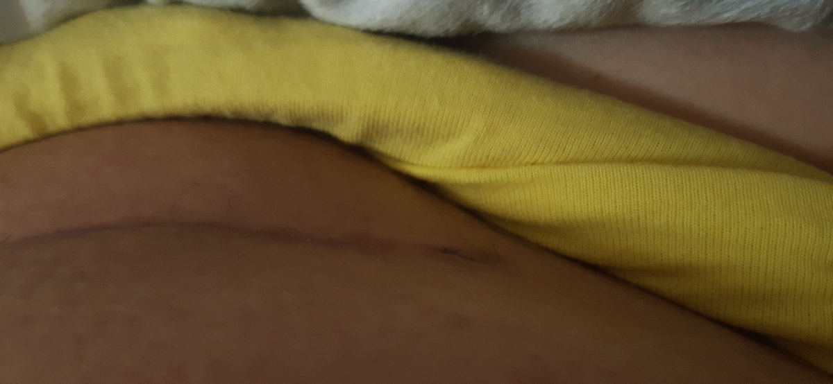 ورم و برآمدگی بالای خط سزارین